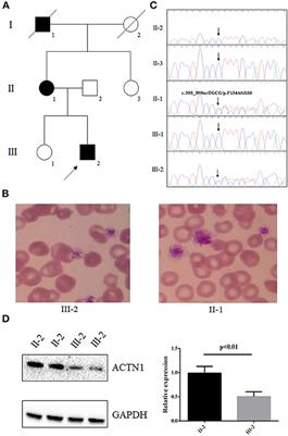 Case Report: Exome Sequencing Identified a Novel Frameshift Mutation of α-Actin 1 in a Chinese Family With Macrothrombocytopenia and Mild Bleeding